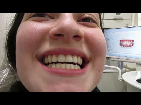 Judie's Invisalign Review