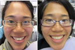 Invisalign Before & After Pictures