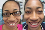 Invisalign Before and After Photos Delaware County
