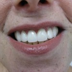 Main Line Teeth Whitening