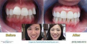 Invisalign Before & After Photos