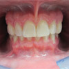 invisalign after photo