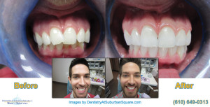 Alan's Before & After Invisalign