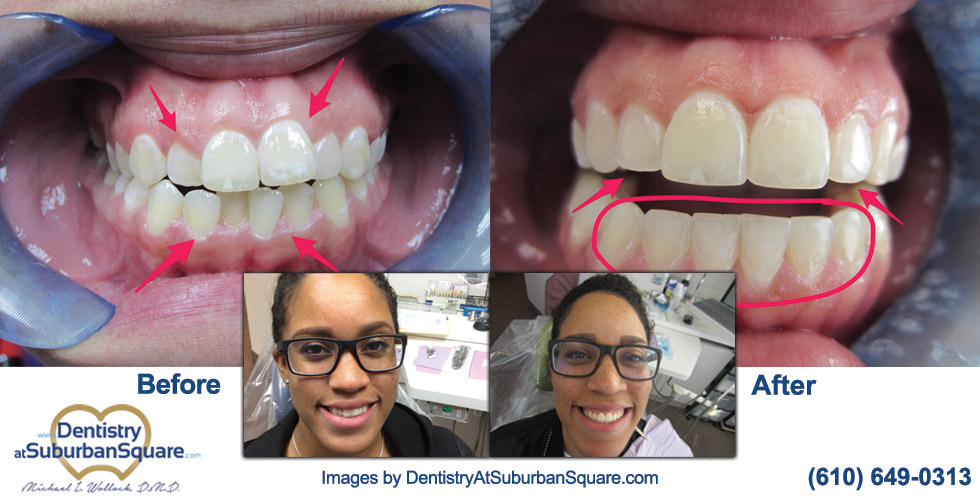 Before & After Invisalign Treatment