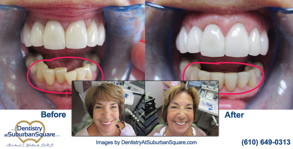 Bunni Invisalign before & After