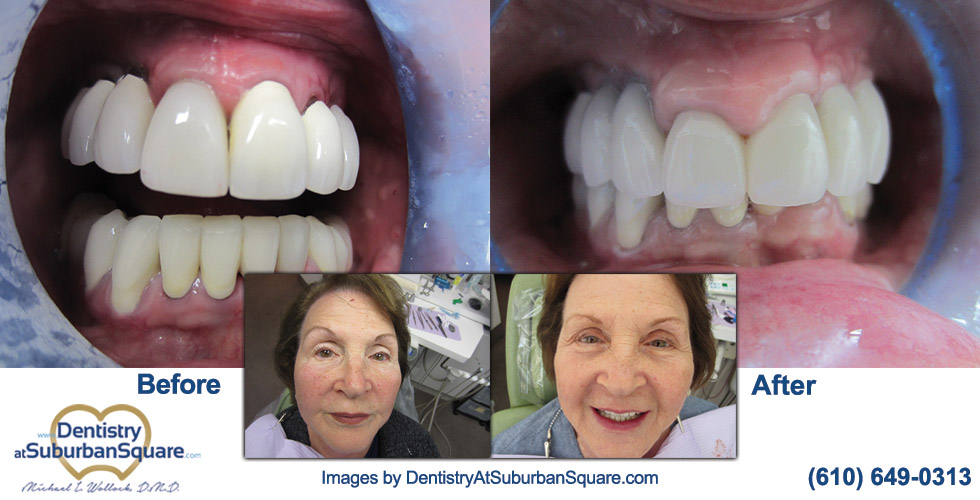Lynn's Before and After Cosmetic Dentistry