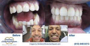 Chris J before and after teeth