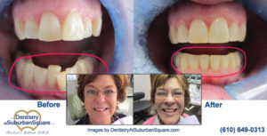 Cynthiann before and after teeth