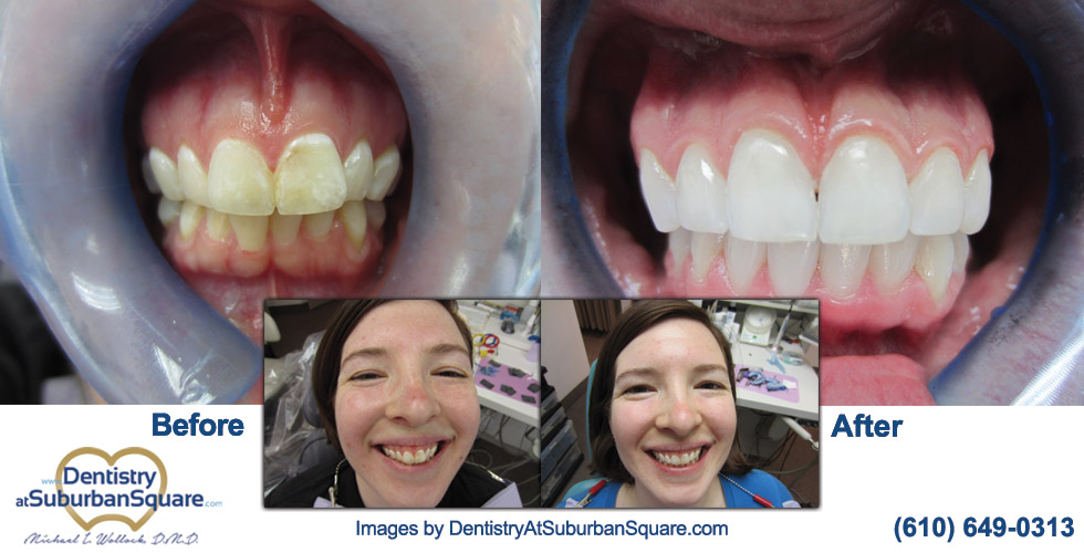 Marta before and after teeth