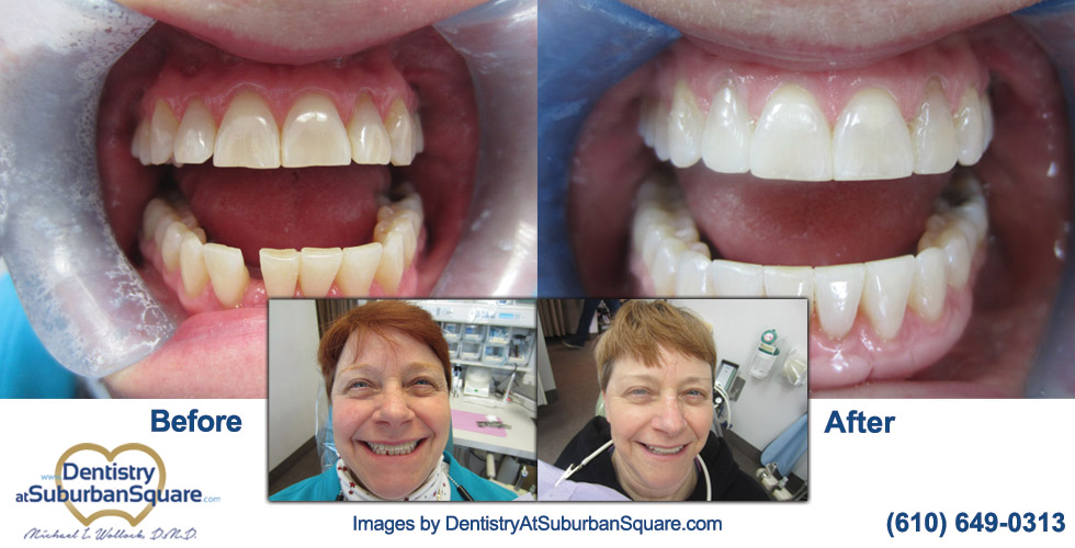 Susan before and after teeth