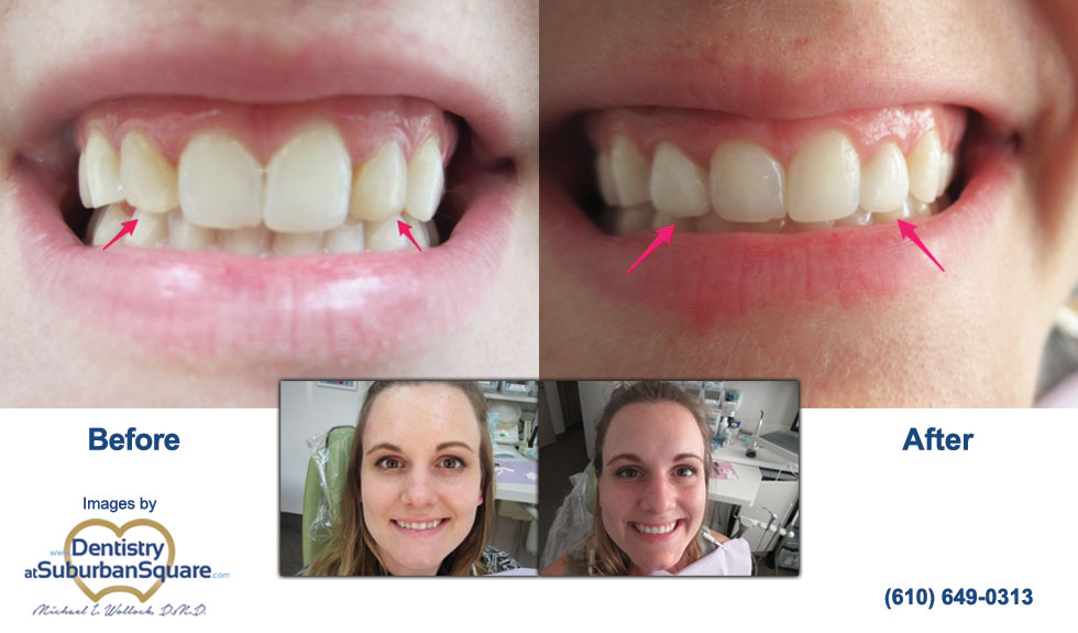 Ali's Cosmetic Dentistry Before and After