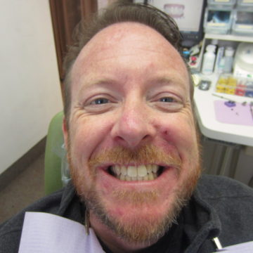 Keith After Invisalign