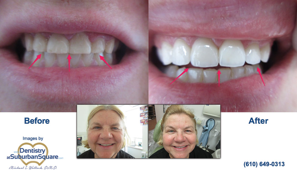 Sally After Cosmetic Dentistry