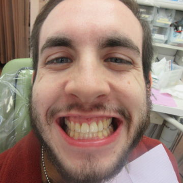 Jonathan After Invisalign