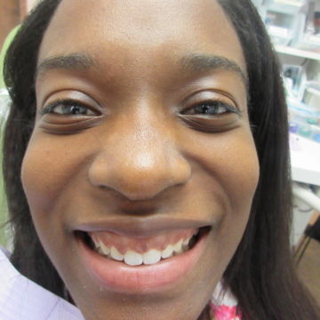 Mikayla after Invisalign
