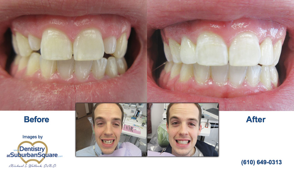 Ryan's before and after cosmetic dentistry photos