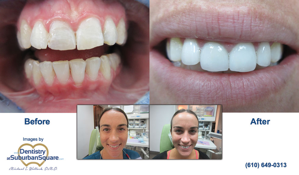 Cara's before and after cosmetic dentistry photos