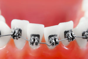 Dental braces super macro , crooked teeth , shallow depth of field
