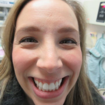 Marykate After Invisalign