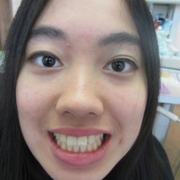 Minh's Full face after Invisalign