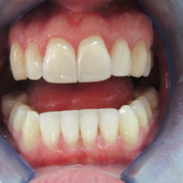 Gordon's Teeth After Invisalign