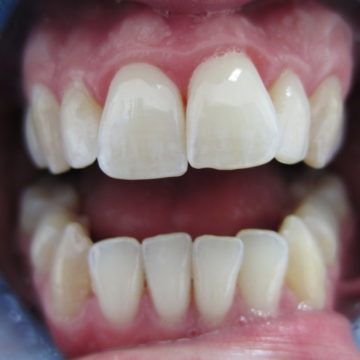 Gordon's teeth before Invisalign