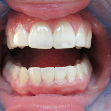 Briannah after Invisalign--closeup of teeth