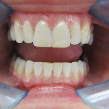 Anabela after Invisalign-closeup of teeth