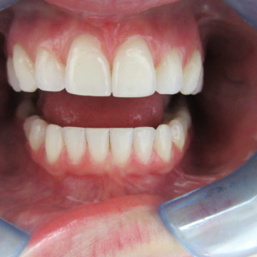 Elena's teeth after Invisalign