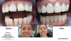 Chau Invisalign Before & After