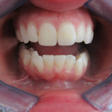 Seana's Teeth Before Invislalign