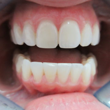 Seanas Teeth After Invisalign