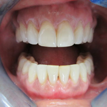 Cynthia After Invisalign, Closeup of Teeth