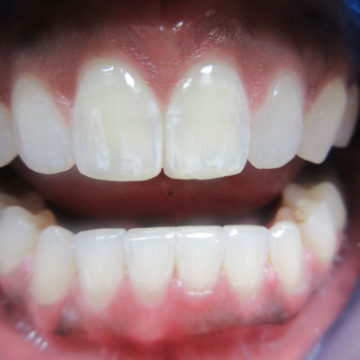 tooth closeup of Anita after Invisalign