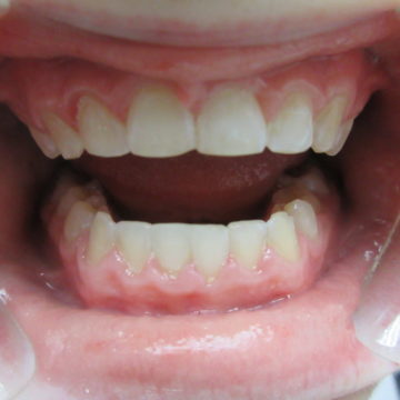 Gyzell After Invisalign