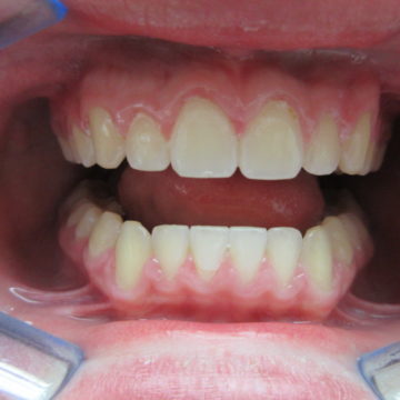 Ben's teeth after Invisalign