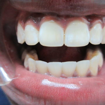 Brianna's teeth after Invisalign