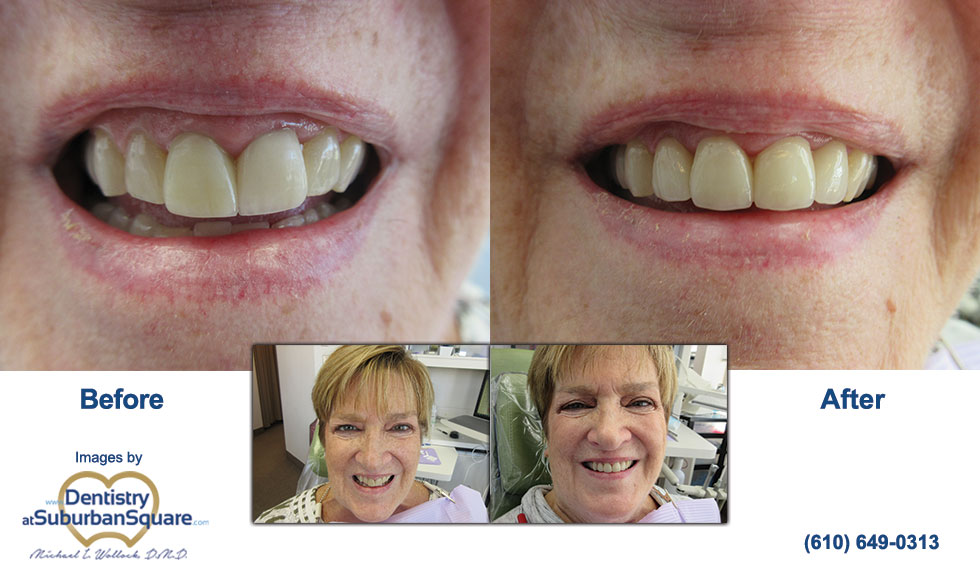 Colette Before and After Dental Crowns