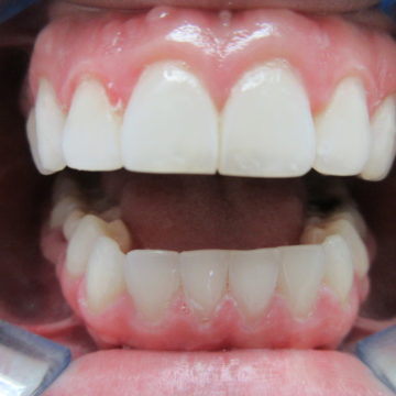 Judy's Teeth After Invisalign