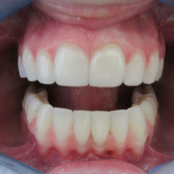 Rachel's Teeth After Invisalign