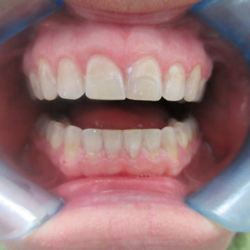 Catherines teeth after Invisalign