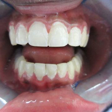 Iha's Teeth After Invisalign