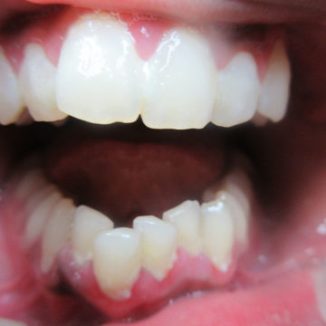 Ihas Teeth Before Invisalign