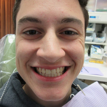 George After Invisalign