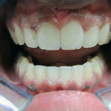 Shalini's teeth after Invisalign
