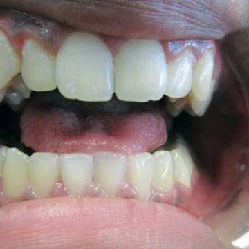 Shalini's teeth before Invisalign