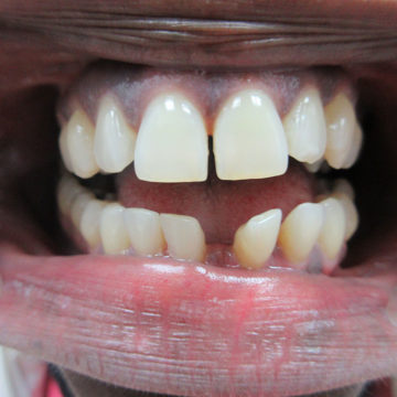 Marie's teeth before Invisalign