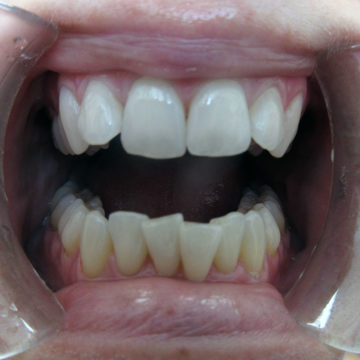 Mandi's teeth before invisalign