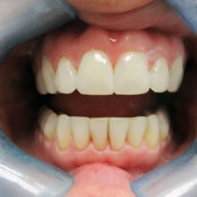 Mandi's teeth after Invisalign