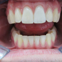 Christian's Teeth After Invisalign